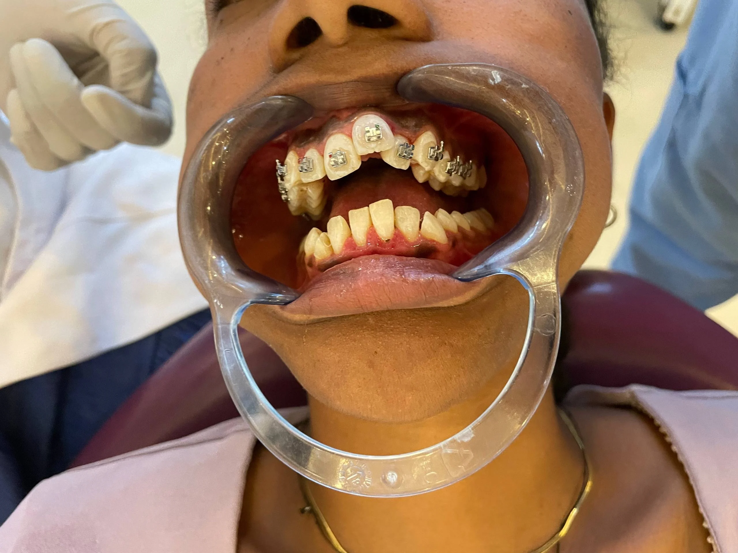 Braces treatment — After