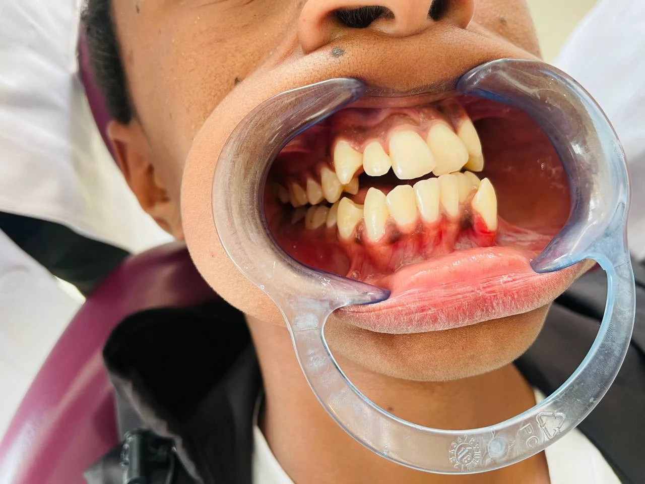 Braces treatment — Before