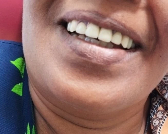 Flexible denture with anterior ceramic — After