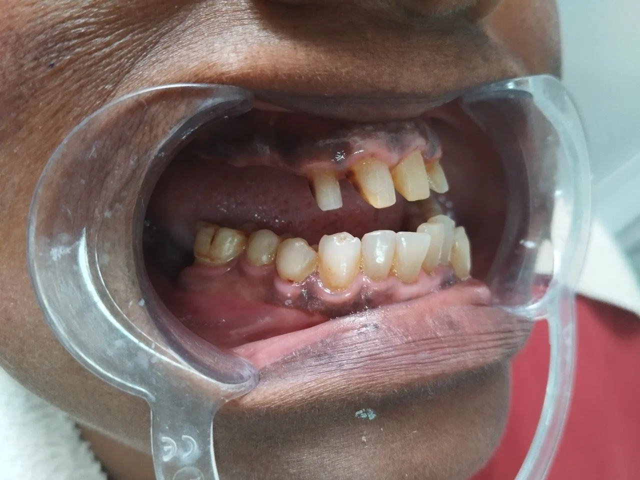 Flexible denture with anterior ceramic — Before