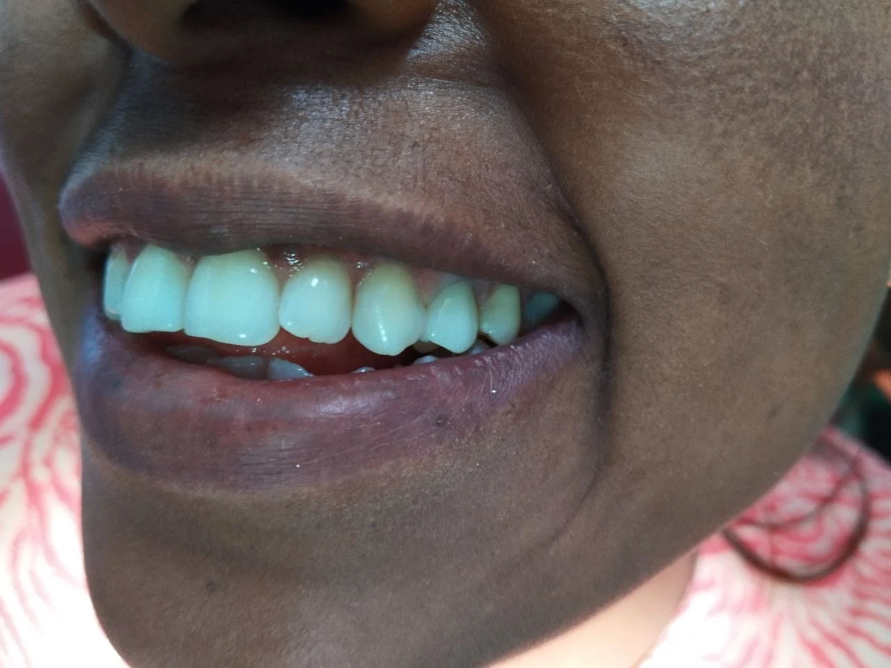 1-unit zirconia bridge — After