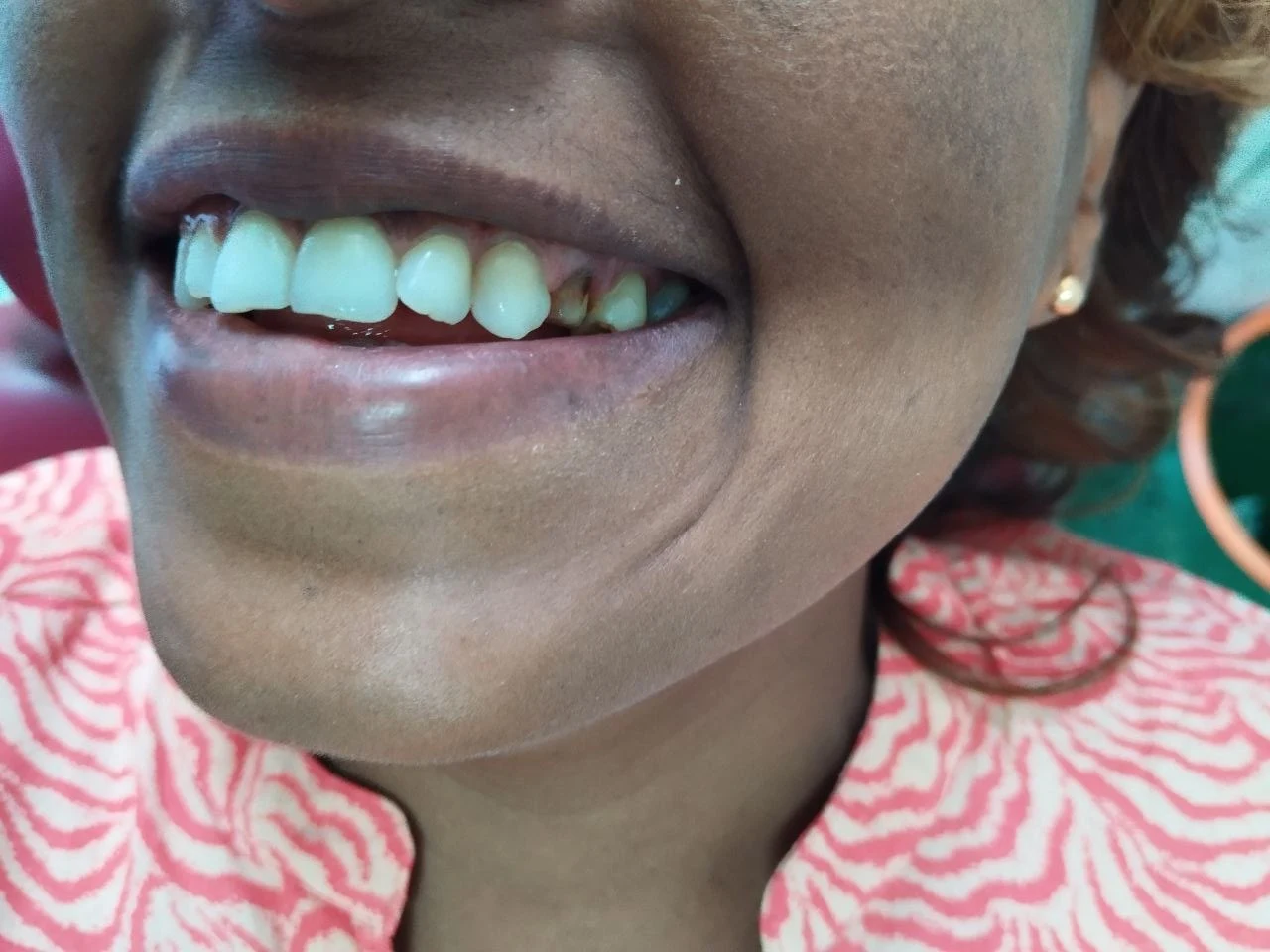 1-unit zirconia bridge — Before