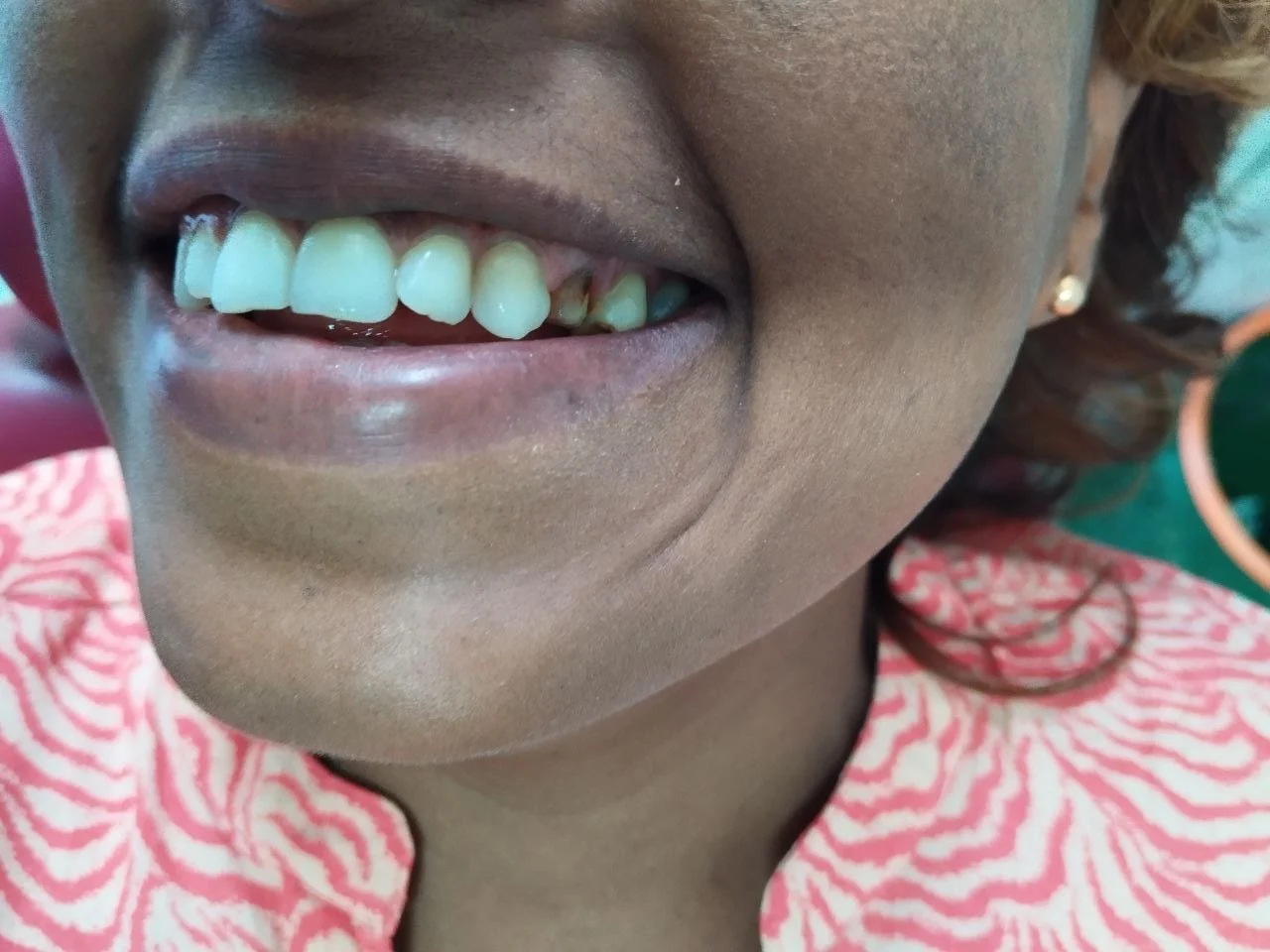 1-unit zirconia bridge — Before