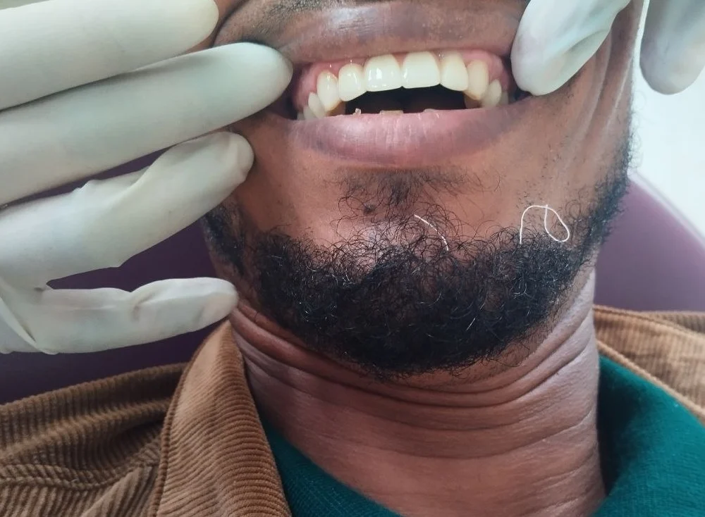 4-unit zirconia bridge — After