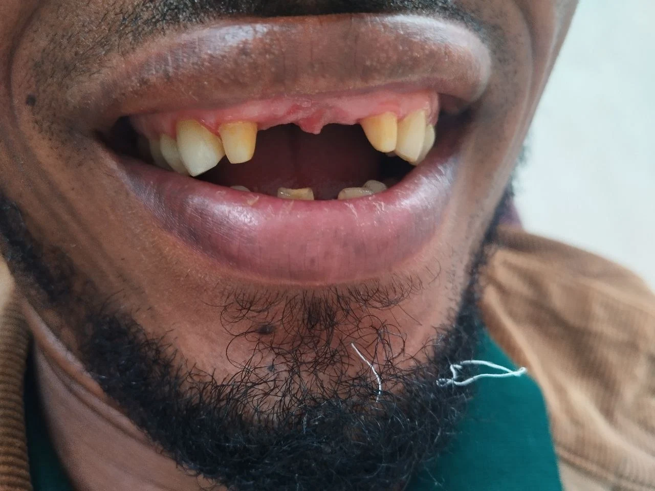 4-unit zirconia bridge — Before