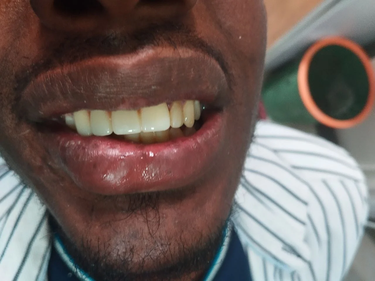 4-unit zirconia bridge — After