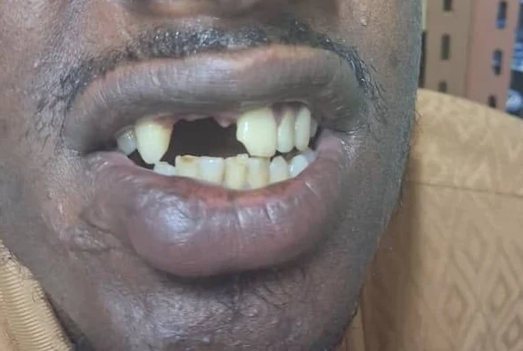 4-unit zirconia bridge — Before