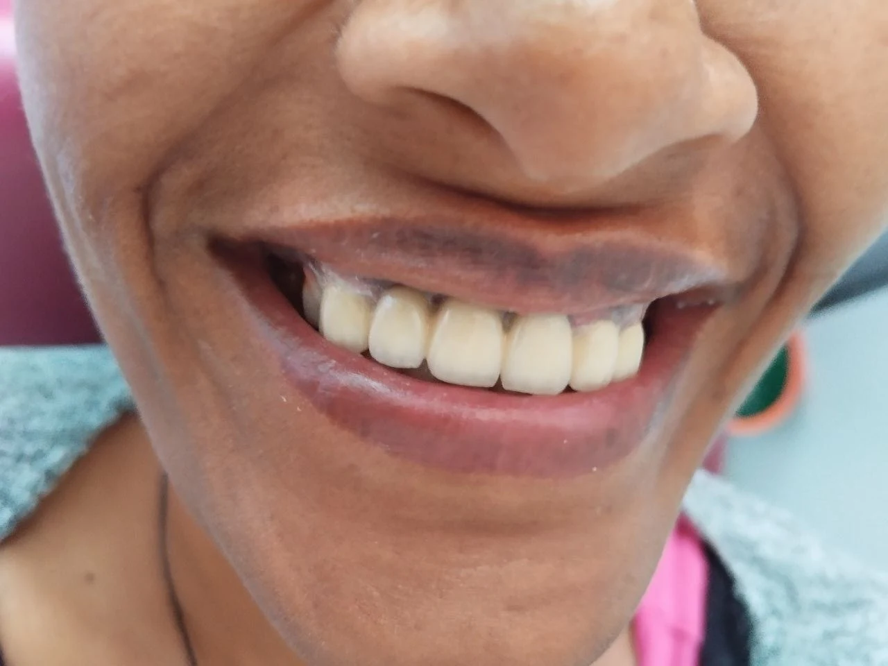 6-unit zirconia bridge — After