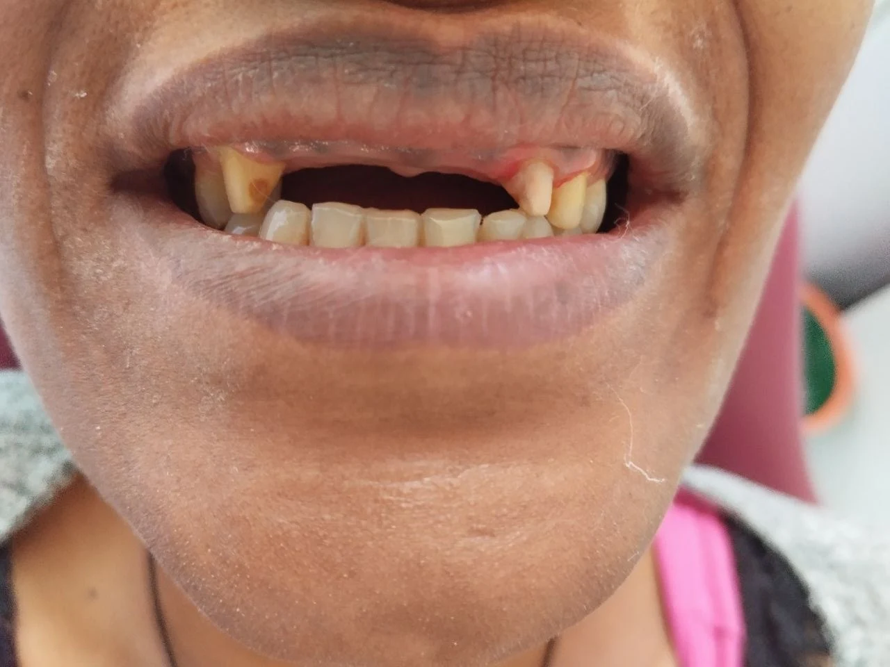 6-unit zirconia bridge — Before